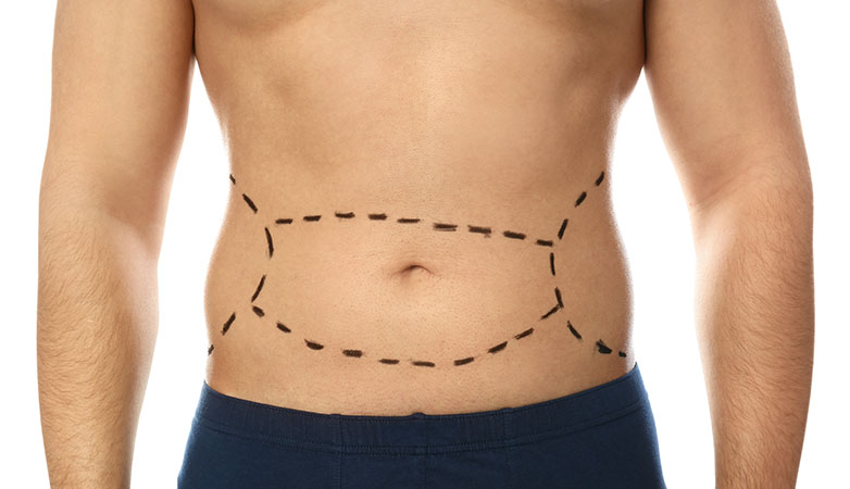 Liposuction